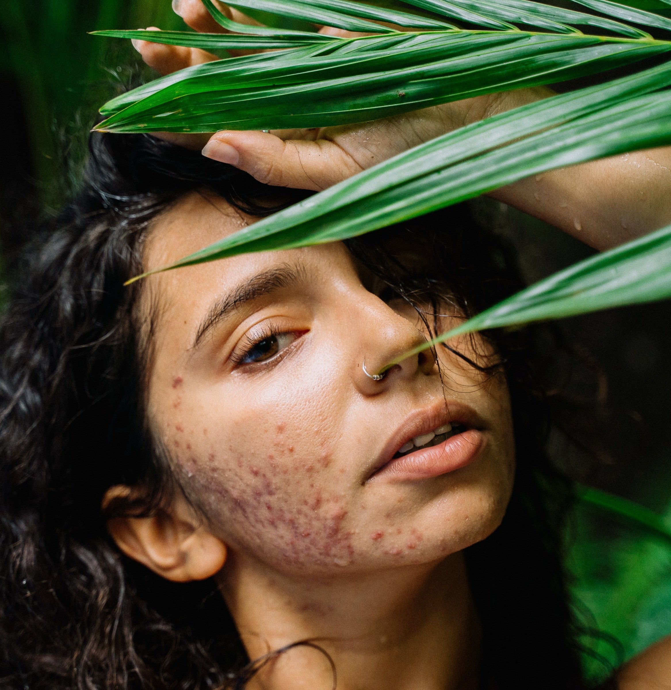 Woman with acne scars